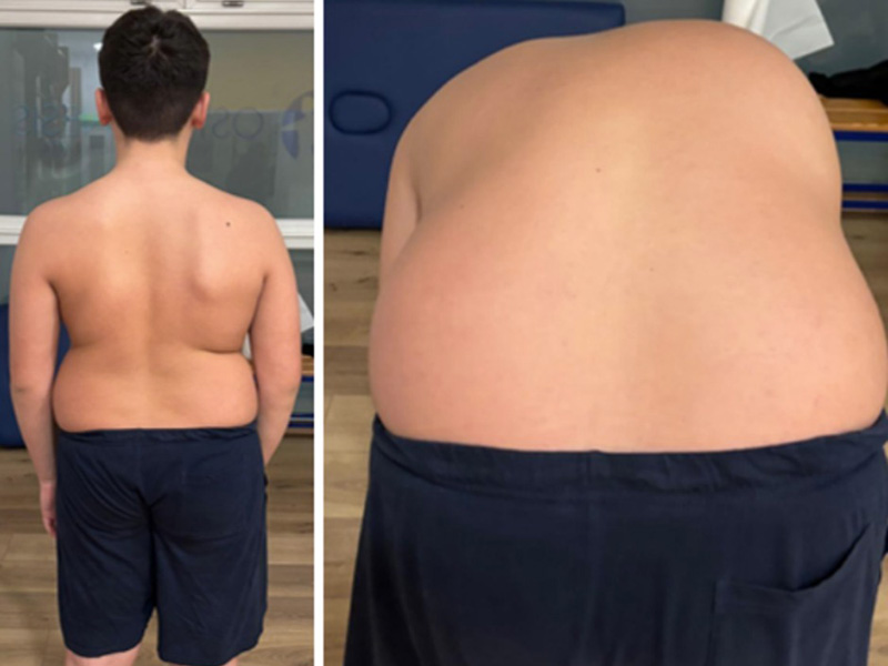 Risultati durante il percorso fisioterapico per scoliosi