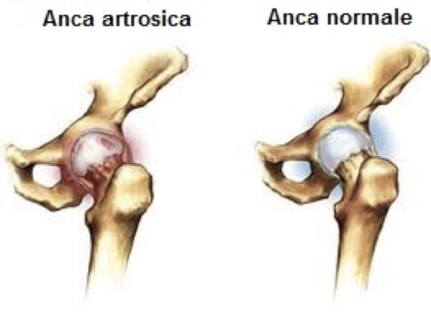 artrosi dell'anca