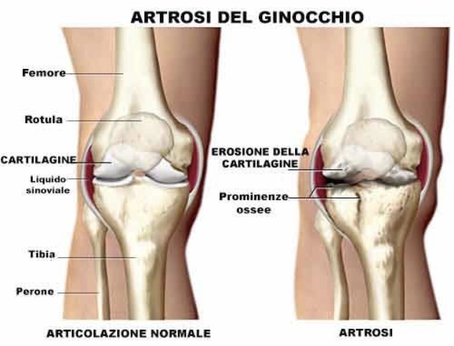 Artrosi del ginocchio