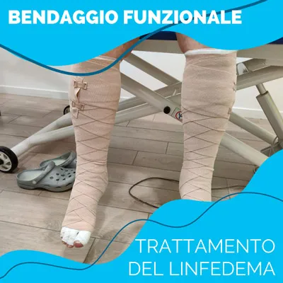 bendaggio gambe linfedema