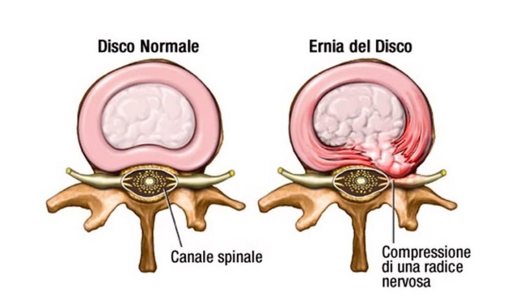 Cause stenosi vertebrale