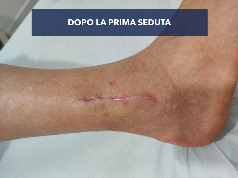 Cicatrice dopo il trattamento fisioterapia dermatofunzionale