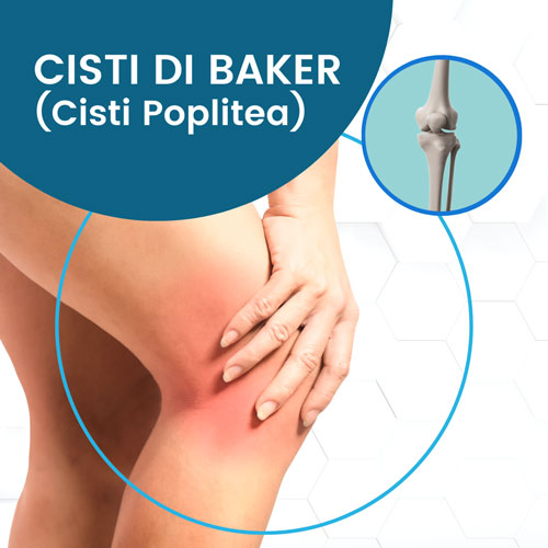 Cisti di baker o poplitea