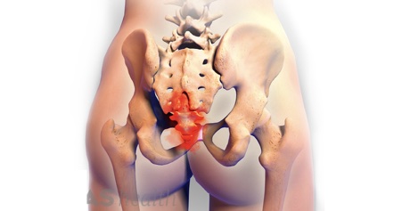 Coccigectomia