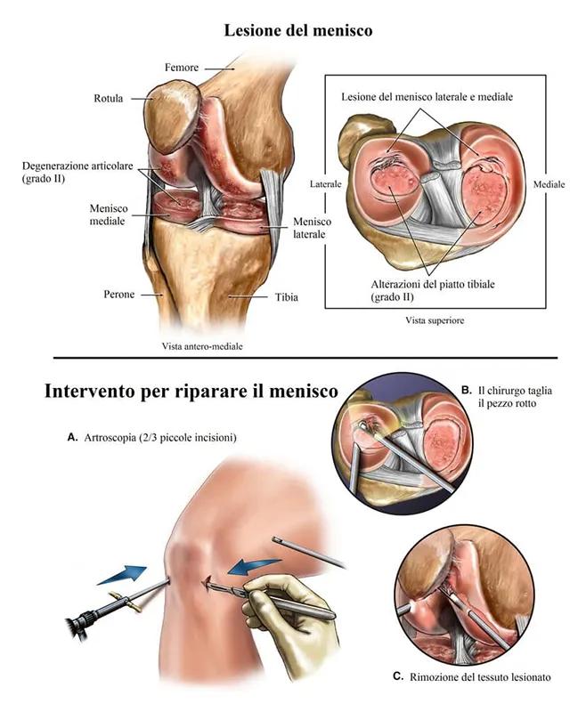 Intervento chirurgico per riparare il menisco