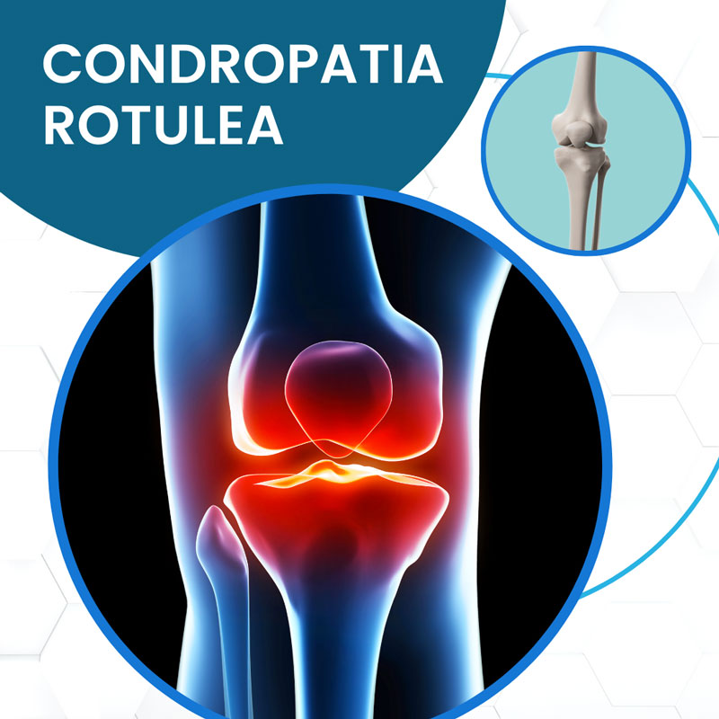 Fisioterapia condropatia rotulea Roma