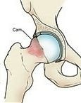 conflitto femoro acetabolare cam