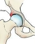 conflitto femoro acetabolare pincer