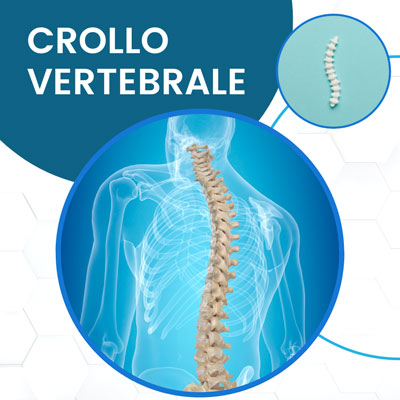 Crollo vertebrale fisioterapia Roma
