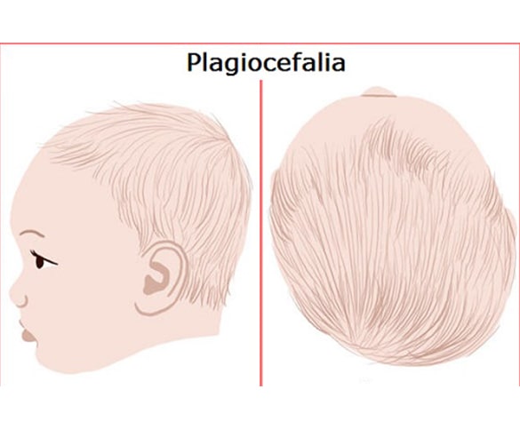 Deformità Craniche Neonatali  Plagiocefalia