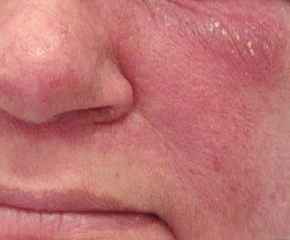 Fisioterapia per la dermatomiosite a Roma