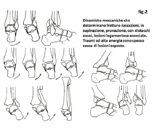 dinamiche meccaniche lesioni caviglia