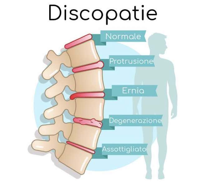 tipologie di discopatie