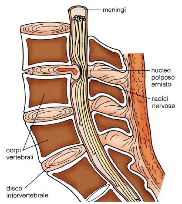 Anatomia ernia del disco