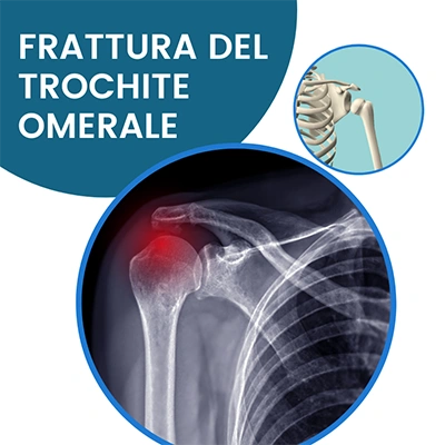 Frattura trochite omerale