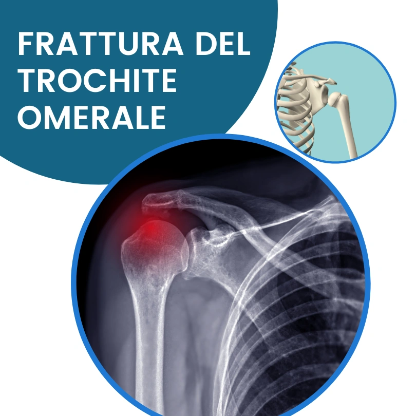 Frattura trochite omerale