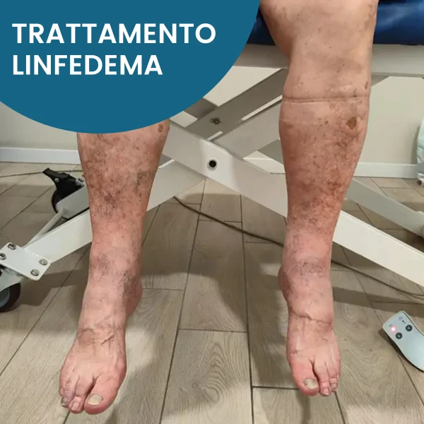 Linfedema e trattamento fisioterapico Linfedema e trattamento fisioterapico