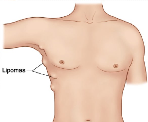 Lipoma