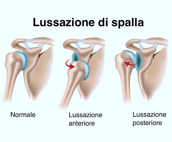 Lussazione Spalla