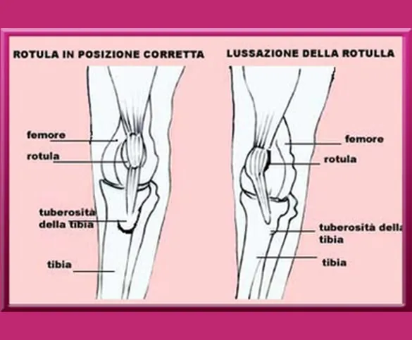 Lussazione della Rotula