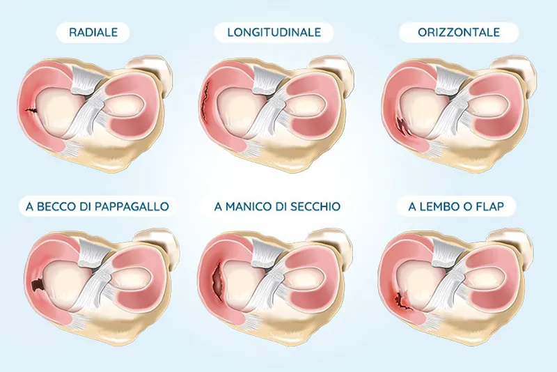 Tipologie di lesione del menisco