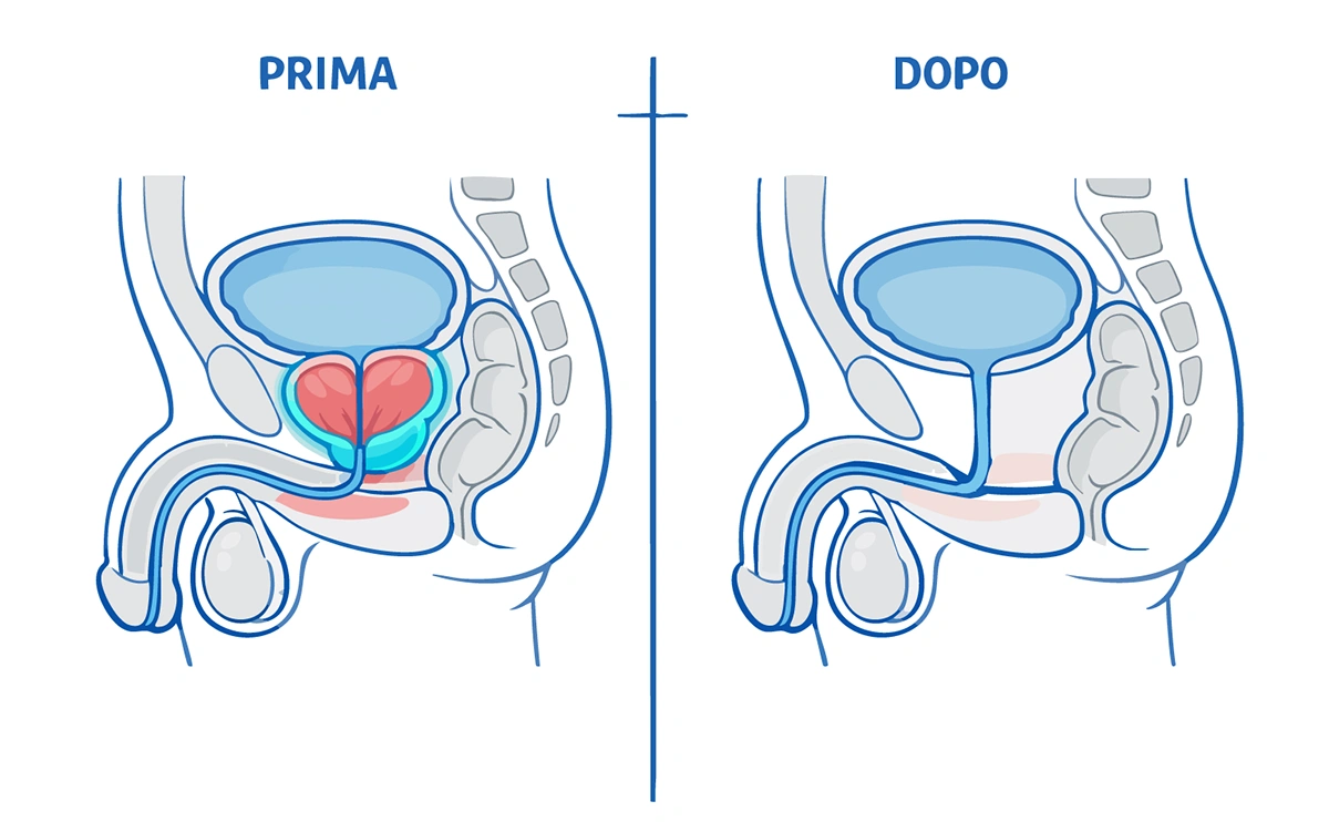Prostatectomia: terapie e recupero