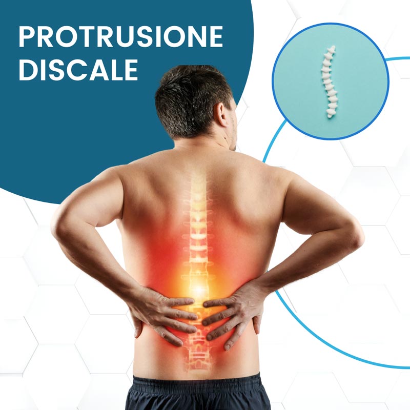 Protrusione discale