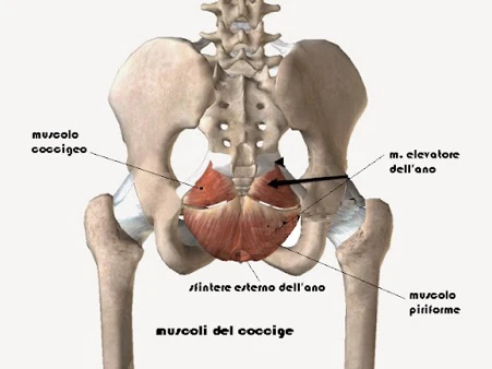 Rimozione chirurgica coccige