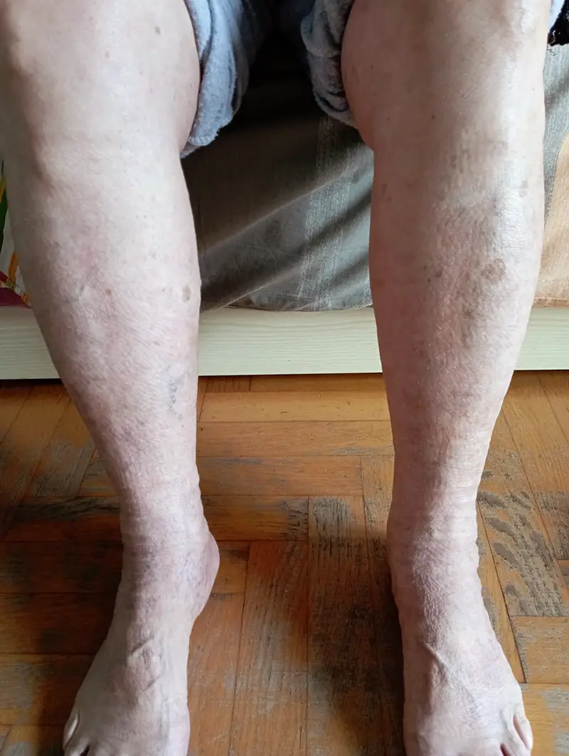 risultato terapia bendaggi gambe