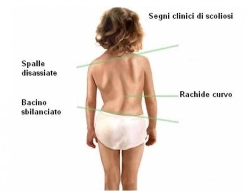 ginnastica posturale scoliosi bambini