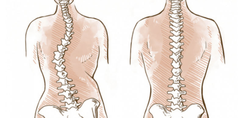 fisioterapia per Scoliosi Roma