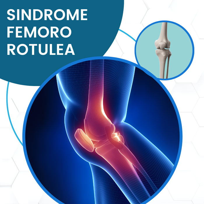 Sindrome Femoro Rotulea