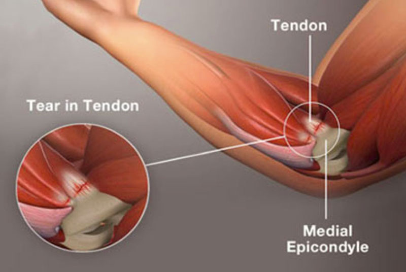 sintomi e cause epitrocleite mediale