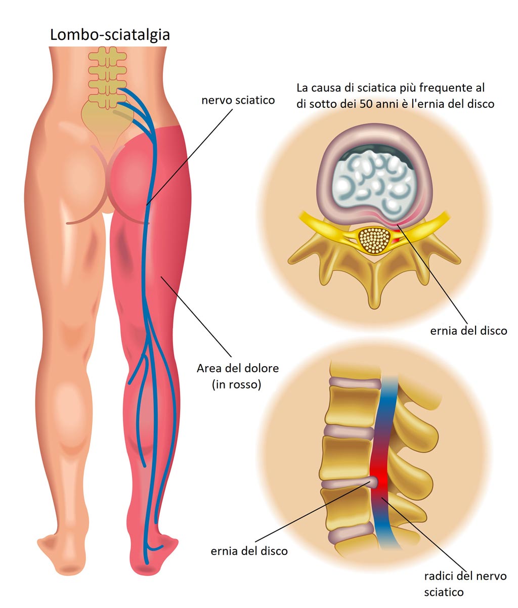 Sintomi stenosi vertebrale