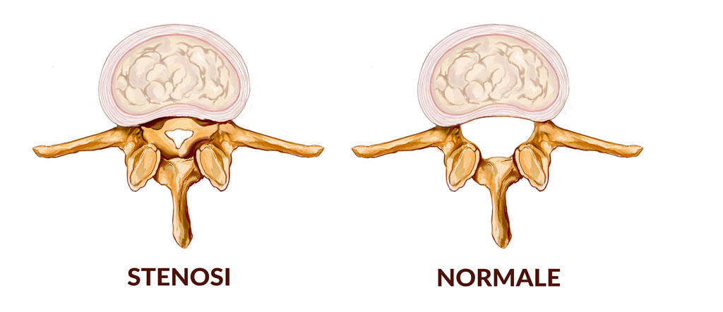 Stenosi Vertebrale