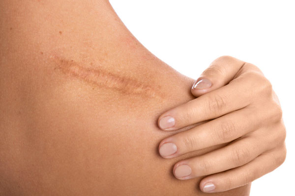 Trattamento delle Cicatrici con la Fisioterapia