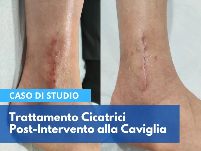 Trattamento fisioterapico cicatrici