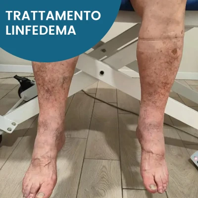 Trattamento Linfoedema (linfedema) Trattamento Linfoedema (linfedema)