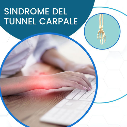 Sindrome del tunnel carpale