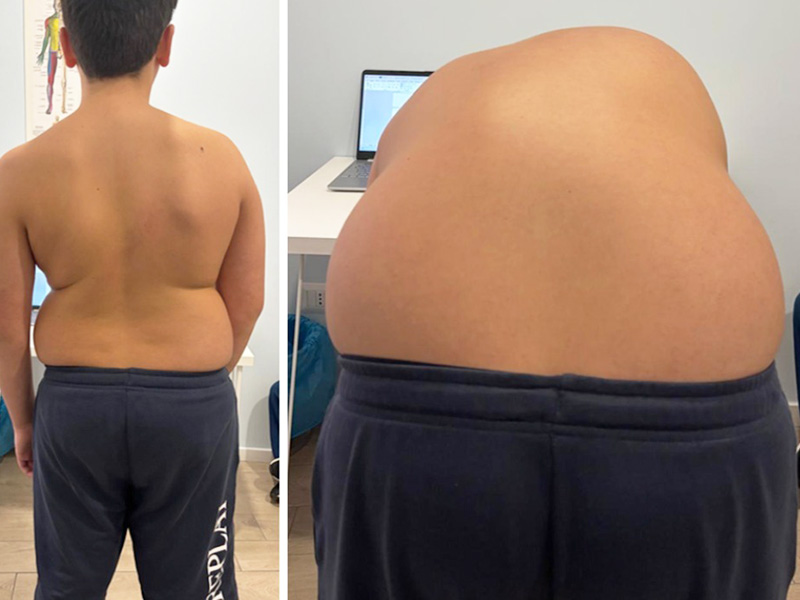 Prima del trattamento fisioterapico della scoliosi