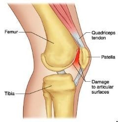 Sindrome Femoro Rotulea